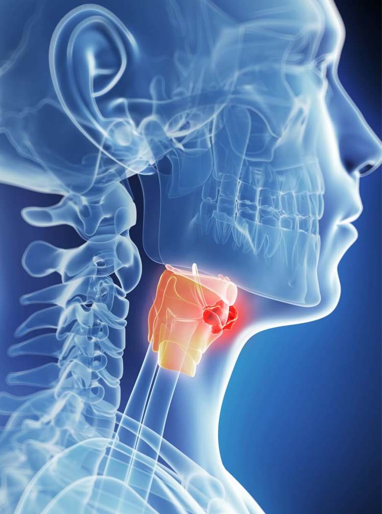 cirurgia-laringe